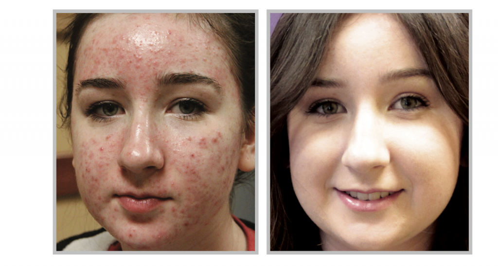 BBL Laser Acne Treatment Before and After