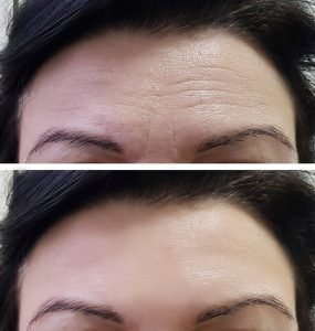 Botox Results Silver Spring