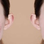 Acne Scar Treatments Near Rockville