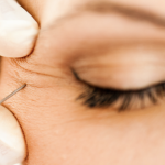 Erase Wrinkles With Botox in Bethesda MD