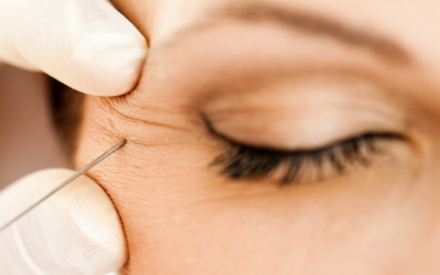 Erase Wrinkles With Botox in Bethesda, MD