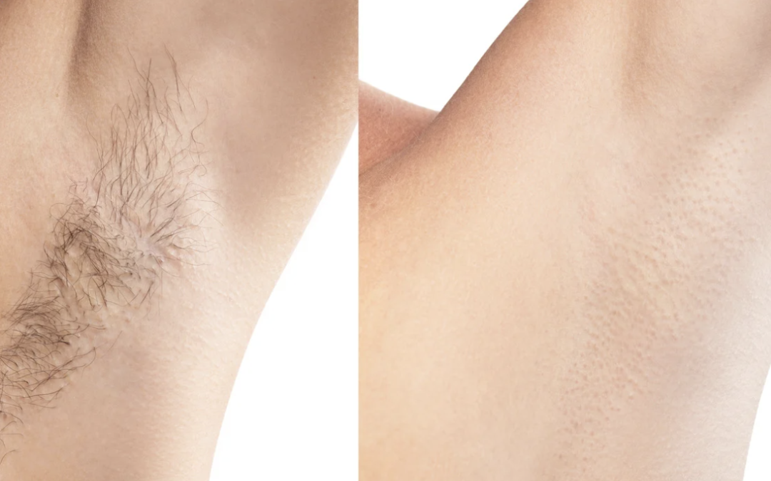 Affordable Laser Hair Removal Packages