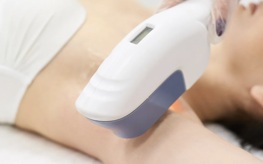 Laser Hair Removal in North Potomac MD