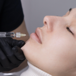Natural-Looking Lip Filler Results Near Takoma MD