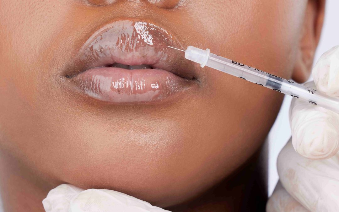 Lip Filler Consultations for Natural Results in Potomac, Maryland
