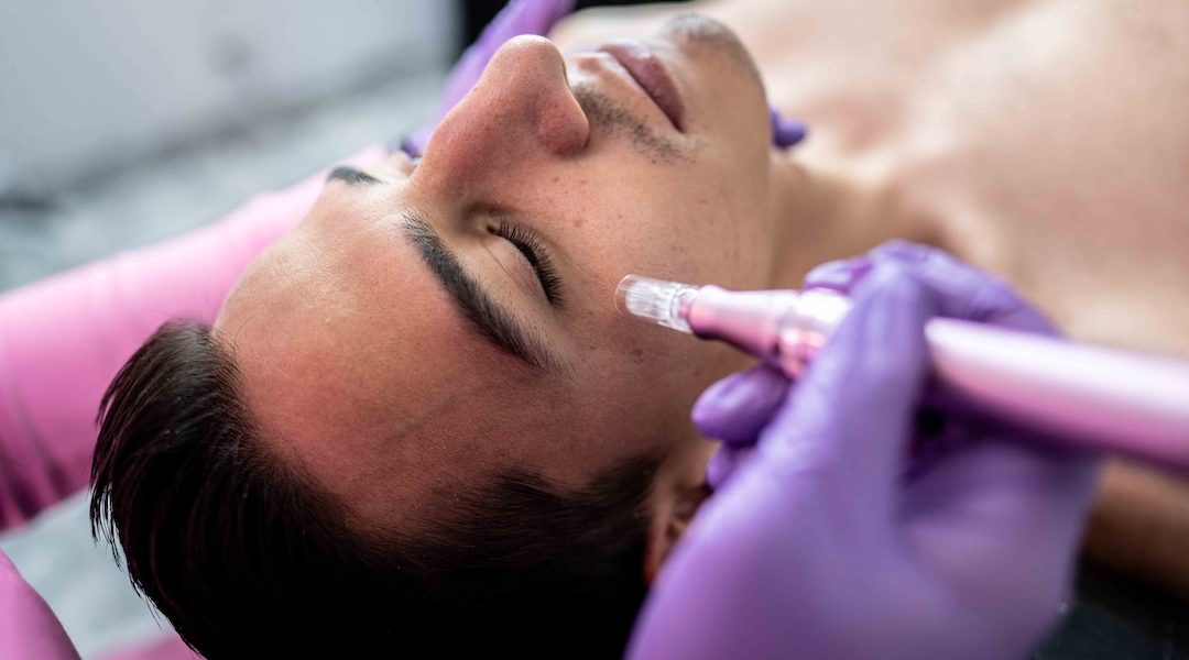 Morpheus8 Style RF Microneedling Results in North Bethesda, MD