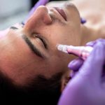 Morpheus8 Style RF Microneedling Results in North Bethesda MD