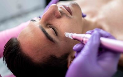 Morpheus8 Style RF Microneedling Results in North Bethesda, MD