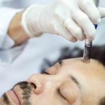 Radiofrequency Microneedling Skin Tightening Pricing in Chevy Chase MD