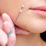 Thread Lift in Bethesda MD