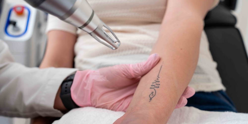 Laser Tattoo Removal Near Bethesda, MD