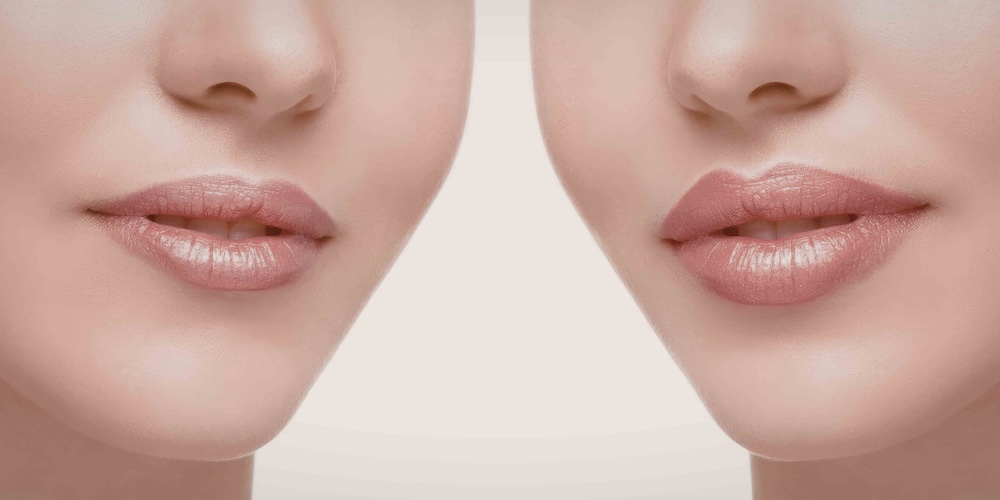 How Much Do Lip Fillers Cost and Are They Worth It