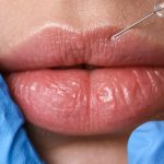 Lip Filler Near North Potomac Maryland
