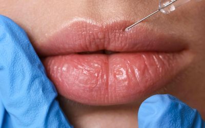 Your Guide to Lip Filler Near North Potomac, Maryland
