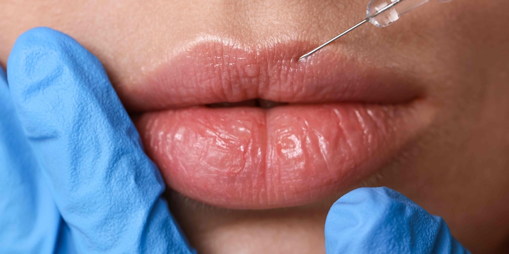 Your Guide to Lip Filler Near North Potomac, Maryland