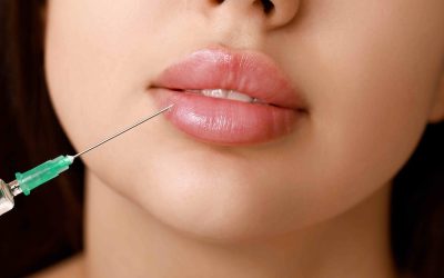 Lip Filler Consultation in North Potomac, MD for Natural Volume