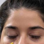 Under Eye Hollow Treatment Options in Rockville MD