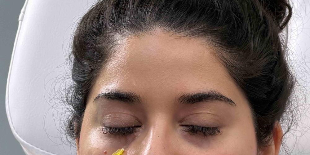 Under Eye Hollow Treatment Options in Rockville MD